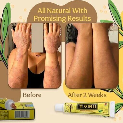 Eczema Herbal Healing Cream