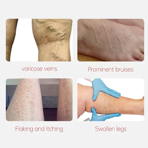 AUQUEST™ Varicose Veins Relief Cream - Image 4