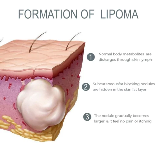 LUMPFree Herbal LipomaRemoval Cream - Image 4