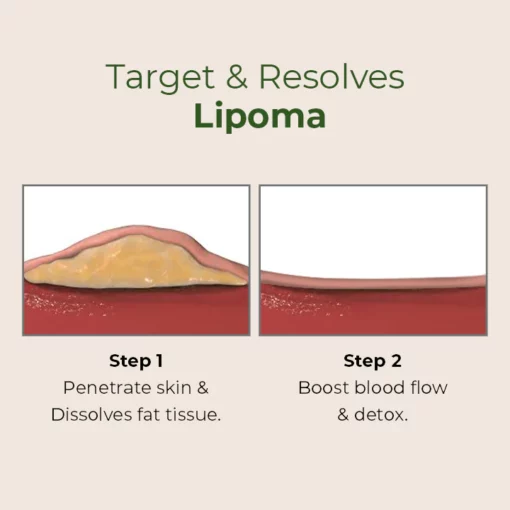 MEDix™ Lipoma Removal Patch - Image 2