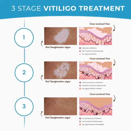 MEDix™ Vitiligo Treatment Cream - Image 4