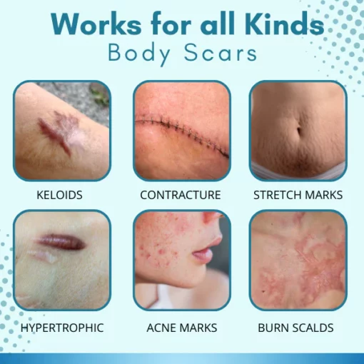 SkinFx™ Scar & Acne Bump Removal Cream - Image 5