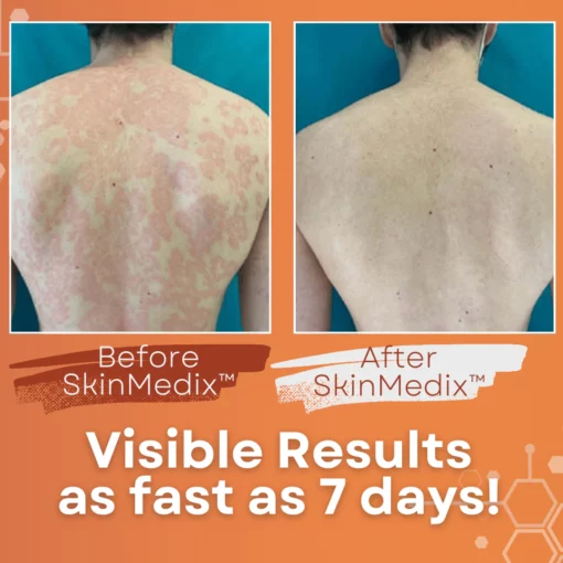 SkinMedix™ Psoriasis Herbal Treatment Cream - Image 4