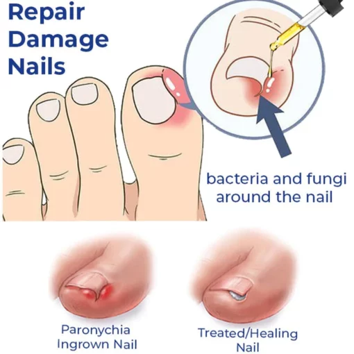 German ToenailCare™ Removal Paronychia Oil - Image 3