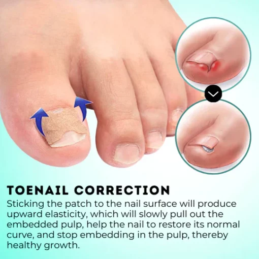 HealPatch™ Ingrown Toenail Corrector - Image 2