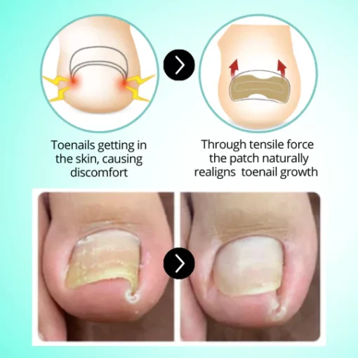 HealPatch™ Ingrown Toenail Corrector - Image 4