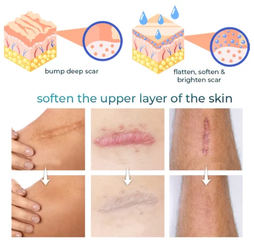 Bioskin™ Advanced Scar Removal Gel - Image 4