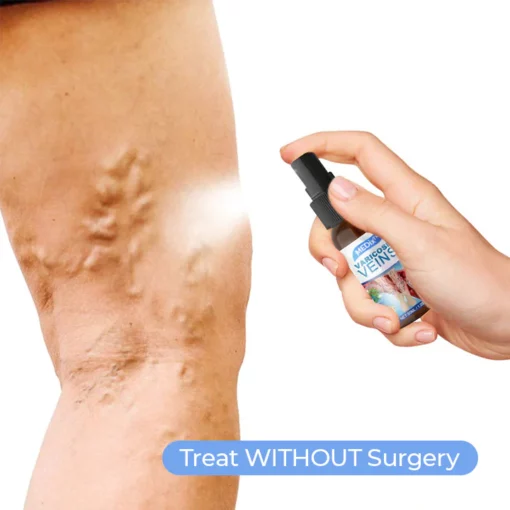 MEDix™ Varicose Veins Spray - Image 3