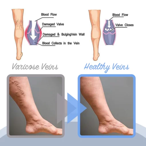 MEDix™ Varicose Veins Spray - Image 4