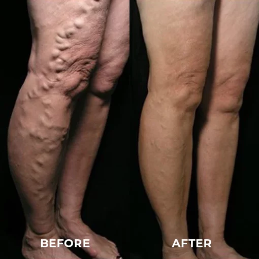 MEDix™ Varicose Veins Spray - Image 6