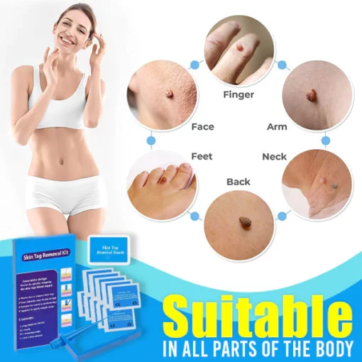 Skin Tag Remover Kit - Image 5