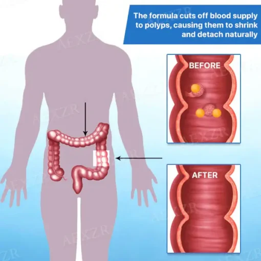 AEXZR™ Colon and Polyps Removal Cure - Image 4