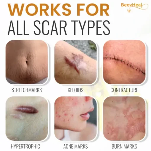 BeevHeal™ Scar Removal Spray - Image 3