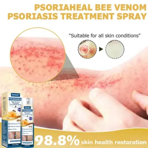 Cvreoz™ PsoriaHeal Bee Venom Psoriasis Treatment Spray - Image 5