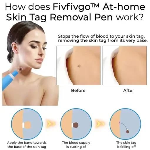 Fivfivgo™ At-Home Skin Tag Removal Pen - Image 2