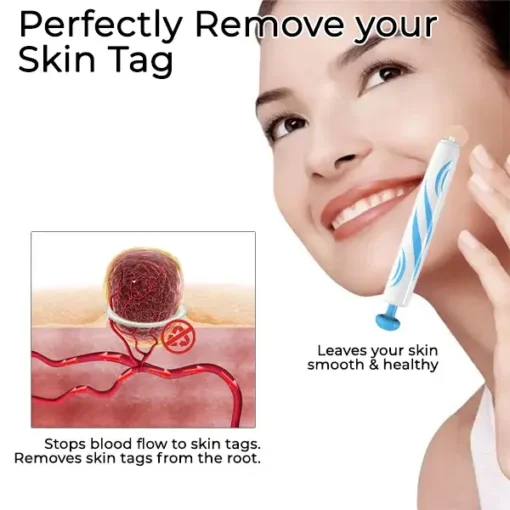 Fivfivgo™ At-Home Skin Tag Removal Pen - Image 3