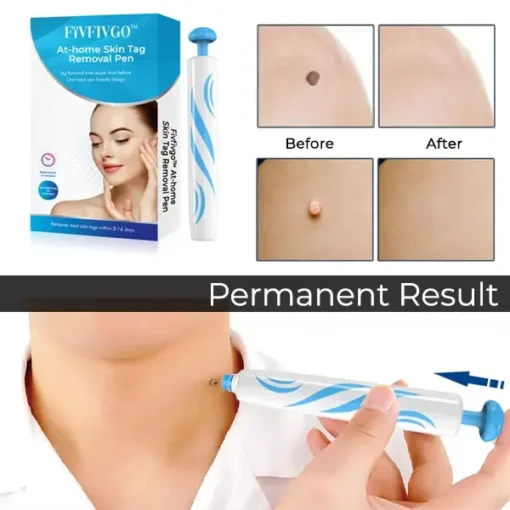 Fivfivgo™ At-Home Skin Tag Removal Pen - Image 4