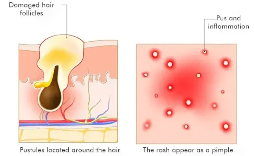 AEXZR™ Folliculitis Clearing Spray - Image 12