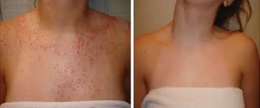 AEXZR™ Folliculitis Clearing Spray - Image 13