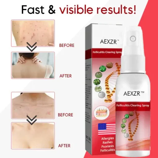 AEXZR™ Folliculitis Clearing Spray - Image 4