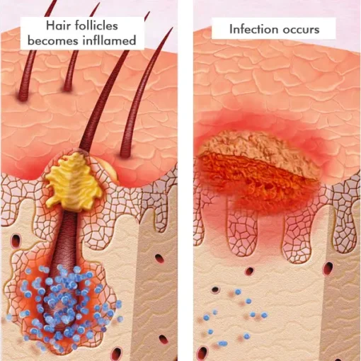 AEXZR™ Folliculitis Clearing Spray - Image 9