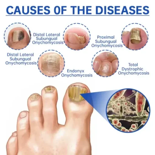 Bikenda™ PureNail Fungus Laser Device - Image 7