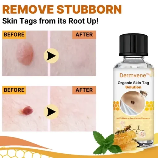 Dermvene™ Organic Skin Tag Solution - Image 6