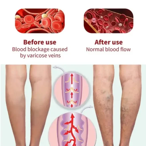 LOVILDS™ VaricoseVeins Patch - Image 3